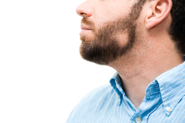Homem com falhas na barba decorrentes de alopecia areata.