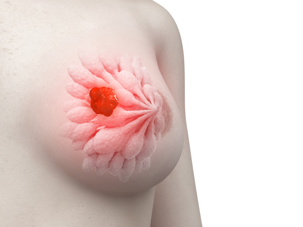 Representação de um tumor na mama, característico do câncer de mama.