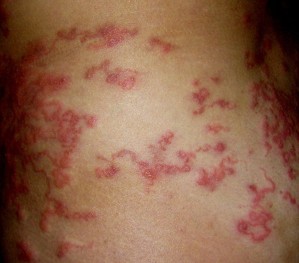 Lesões sinuosas e avermelhadas na pele causadas pelo bicho-geográfico.