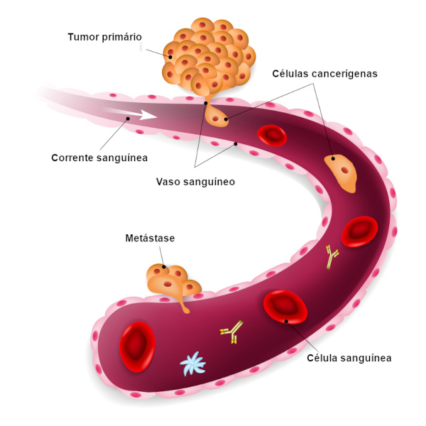  Ilustração de células cancerígenas se deslocando no interior de um vaso sanguíneo, formando metástase.