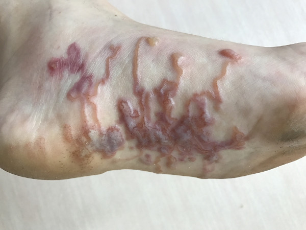 Lesões cutâneas causadas por vermes nematódeos em um pé humano.