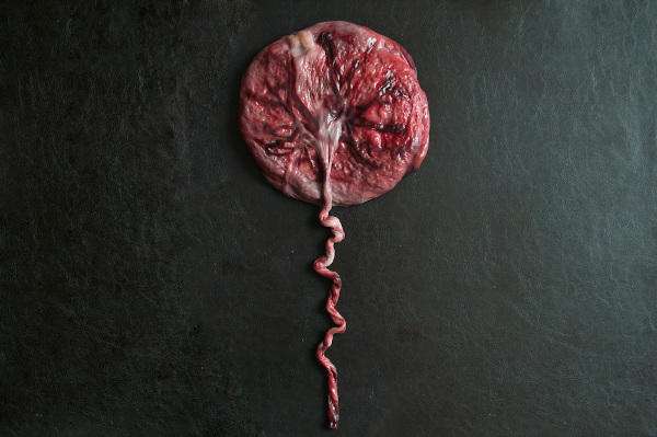 Placenta e parte do cordão umbilical.