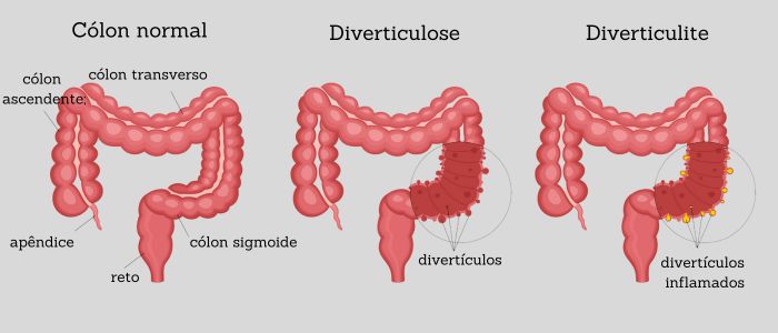 Ilustração mostrando como a lesão de um divertículo no intestino, o que caracteriza a diverticulose, leva à diverticulite.
