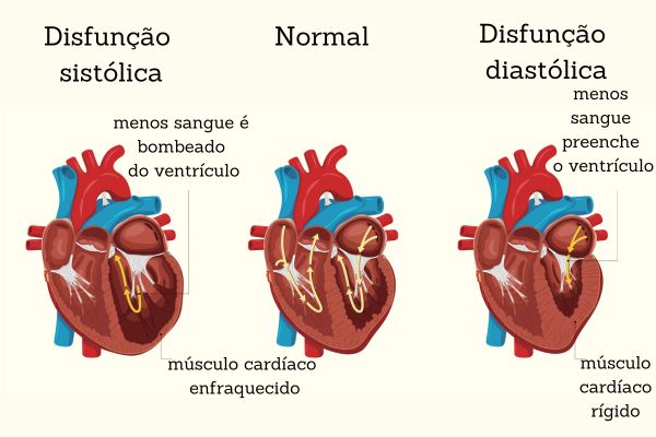 Tipos de insuficiência cardíaca.