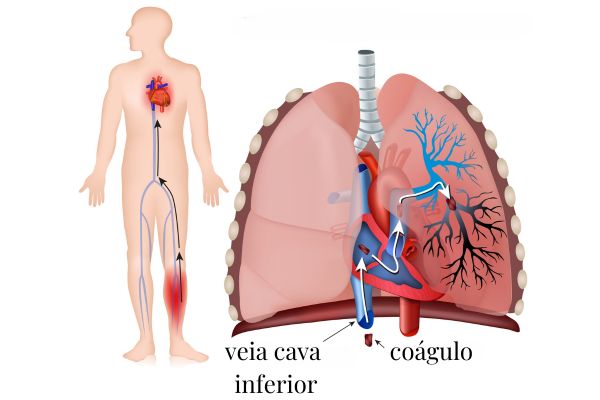 Imagem mostrando a embolia pulmonar causada pela movimentação de um coágulo, uma das causas do tromboembolismo pulmonar.