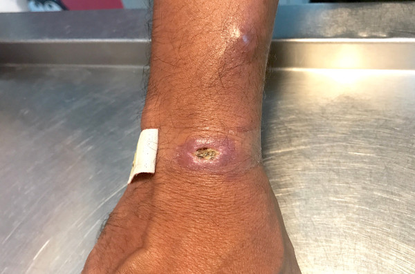 Lesões da esporotricose na pele do braço.
