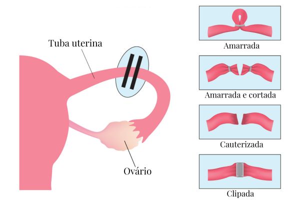 Laqueadura em trompas uterinas do sistema reprodutor feminino.