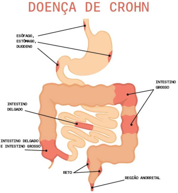 Ilustração representativa da inflamação que ocorre na doença de Crohn.