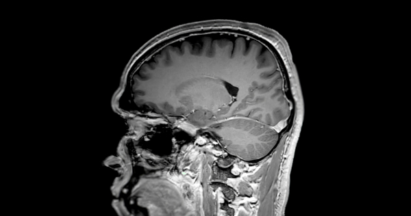 Ressonância magnética cerebral com o gadolínio sinalizando um cérebro normal.