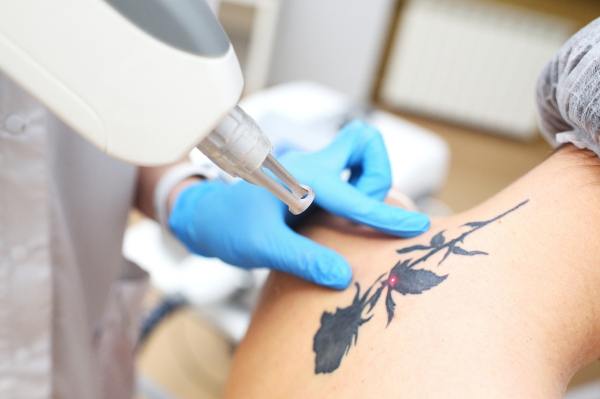 Laser de neodímio sendo usado para remover tatuagem