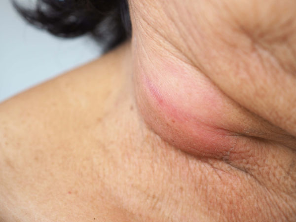 Imagem aproximada do pescoço de uma mulher com os linfonodos aumentados, um dos principais sintomas do linfoma.