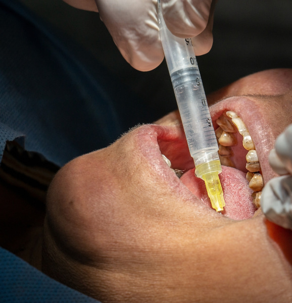 Aplicação de hipoclorito de sódio (NaClO) em tratamento dentário.