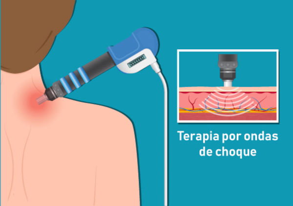 Ilustração representativa da terapia de onda de choque.