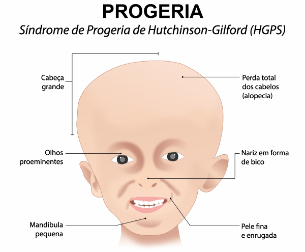 Principais características físicas da Síndrome de Progeria de Hutchinson-Gilford.