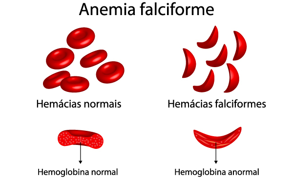 Comparação entre hemácias normais e hemácias falciformes.