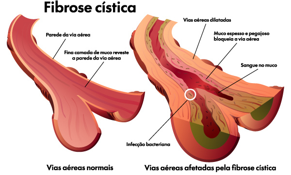 Comparação entre uma via aérea normal e uma via aérea afetada pela fibrose cística.