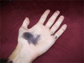 Mão com manchas escuras de nitrato de prata, 17 horas após o contato