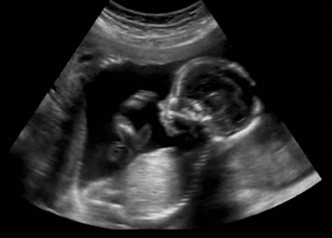 Os exames de ultrassonografia são largamente utilizados para determinar o sexo dos bebês a partir da décima terceira semana de gestação.